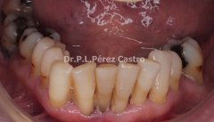 Rehabilitación Oral implantes caso 11