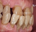 Rehabilitación Oral implantes caso 12
