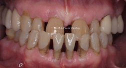 Rehabilitación Oral implantes caso 12