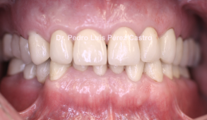 Rehabilitación Oral completa en zirconio Procera