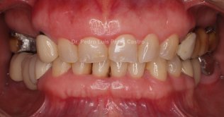 Rehabilitación Oral completa sobre dientes e implantes.