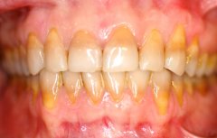 Rehabilitación Oral completa en zirconio caso 7