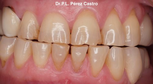 Tratamiento del Tratamiento de la Hipersensibilidad Dental