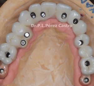 Tipos de tratamientos con prótesis dentales