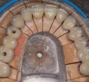 Tipos de tratamientos con prótesis dentales